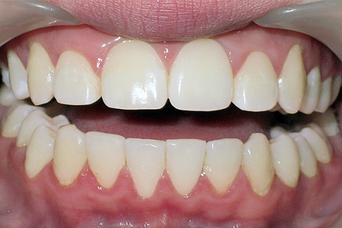 Устранение скученного положения зубов