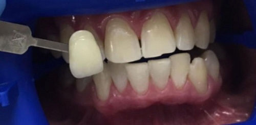 Отбеливание зубов офисной системой Zoom 4