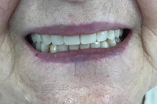 Установка полного и частичного съёмного протезов