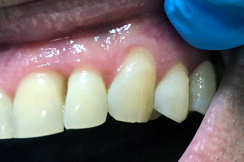 Пластика рецессии десны