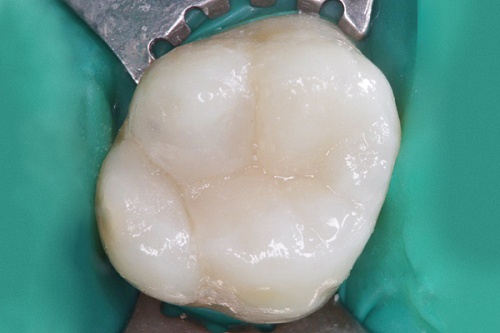 Лечение кариеса