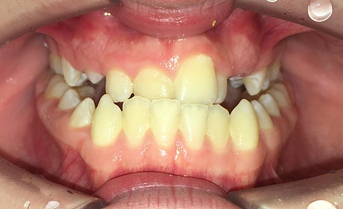 Коррекция сложного случая искривления зубов