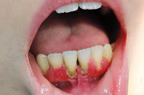 Пластика преддверия и закрытие рецессии десны