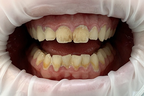 Биогигиена и отбеливание зубов