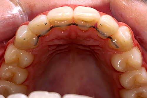 Исправление прикуса брекетами Damon