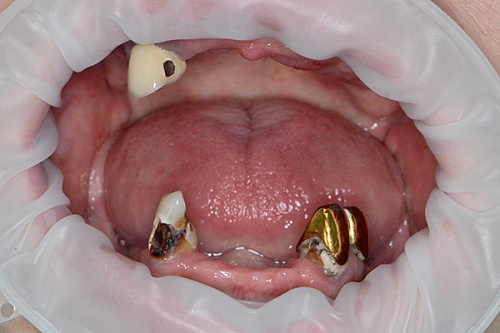 Восстановление зубных рядов по технологии All-on-4