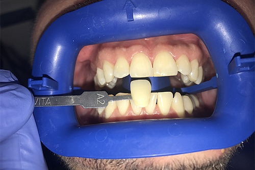 Отбеливание зубов Zoom White Speed