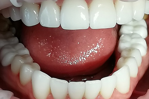 Установка керамических виниров