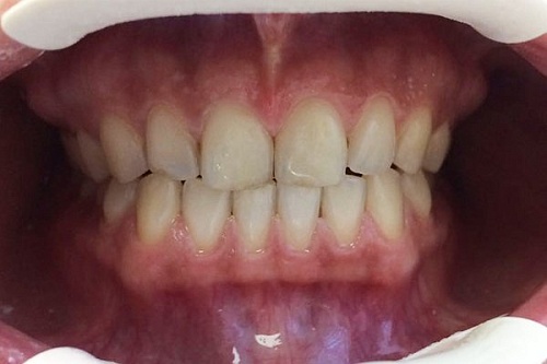 Отбеливание ZOOM 4