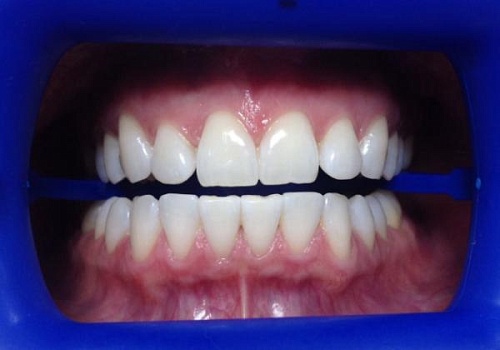 Профессиональное отбеливание зубов Zoom 4