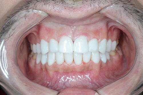 Лечение и протезирование зубов винирами E-max