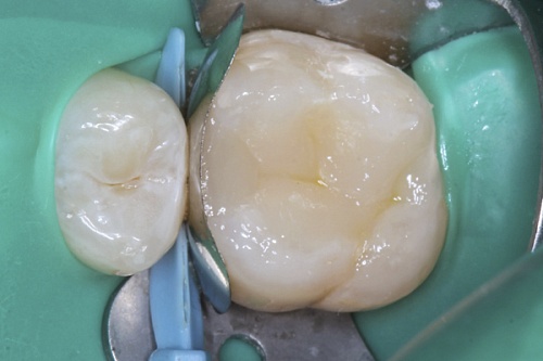 Лечение кариеса материалом Estelite Palfique