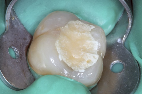 Лечение кариеса материалом Estelite Palfique