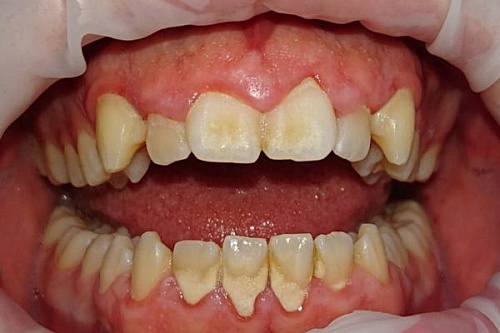 Профессиональная гигиена ультразвуком и Air Flow