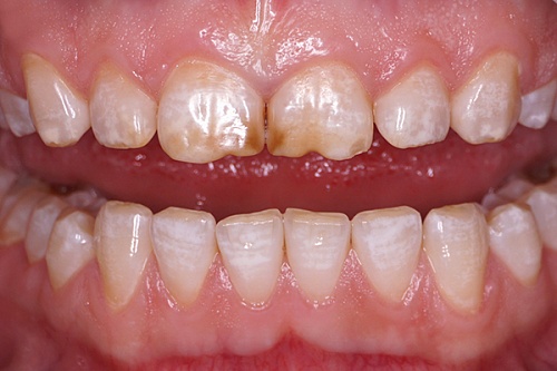 Установка керамических виниров E-max