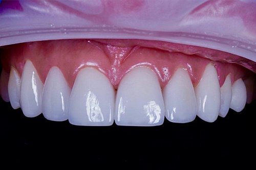 Протезирование винирами E-MAX