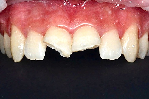 Восстановление центральных резцов керамическими винирами E-Max