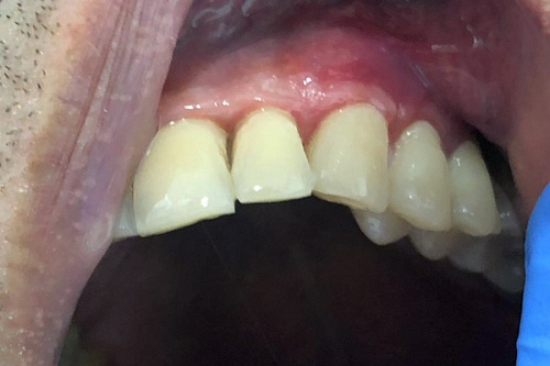 Пластика рецессии десны