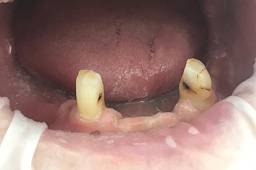 Установка полного и частичного съёмного протезов