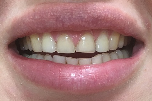 Установка виниров и бескаркасной керамики