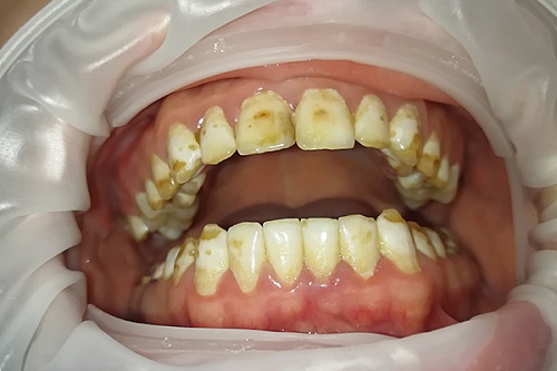 Установка керамических виниров