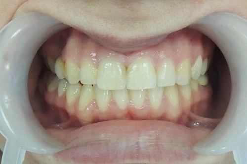 Выравнивание верхнего зубного ряда брекетами Damon Clear