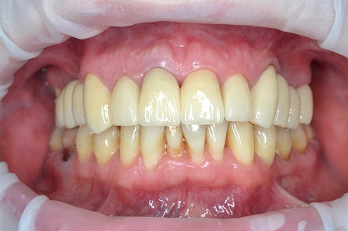 Протезирование с помощью циркониевых коронок с керамическим покрытием