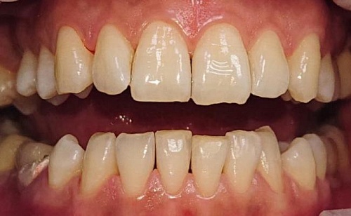 Лечение пародонтита средней тяжести