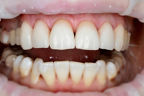 Реставрация зубов