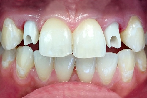 Протезирование коронками на имплантатах