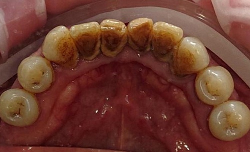 Удаление темного зубного налета