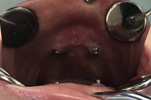 Полное протезирование на зубных имплантах