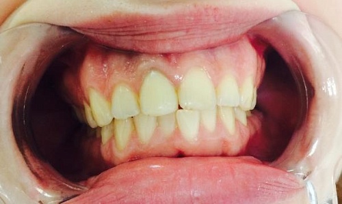 Выравнивание зубов брекетами Damon