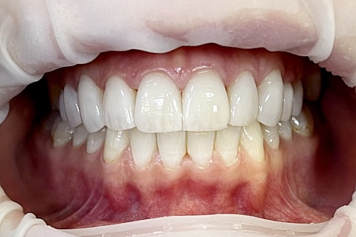 Эстетическая и функциональная реабилитация зубов