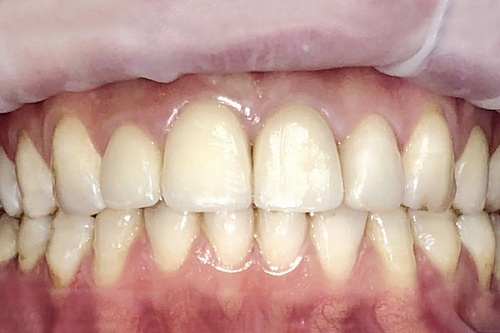 Протезирование фронтальных зубов коронками на имплантах