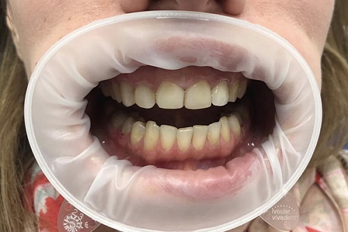 Установка безметалловых коронок