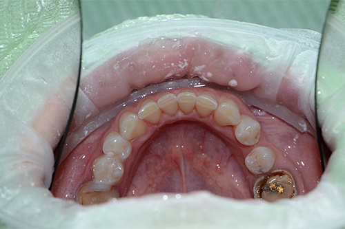 Удаление зубного налета с помощью профгигиены
