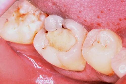 Лечение кариеса материалом Estelite Sigma Quick