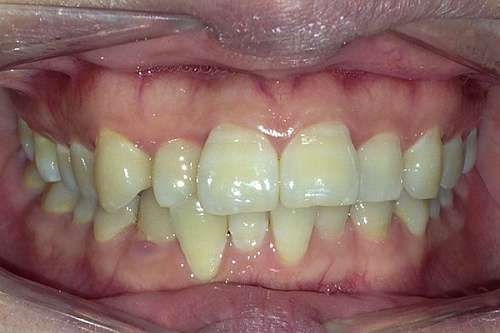 Исправление скученности зубов во фронтальном отделе