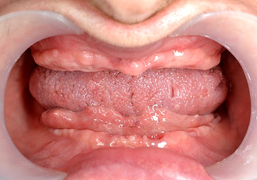 Тотальная реконструкция улыбки с помощью имплантов и керамических коронок E-max