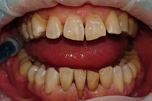 Лечение пародонтита аппаратом Вектор