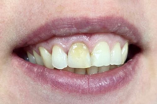 Установка керамических виниров