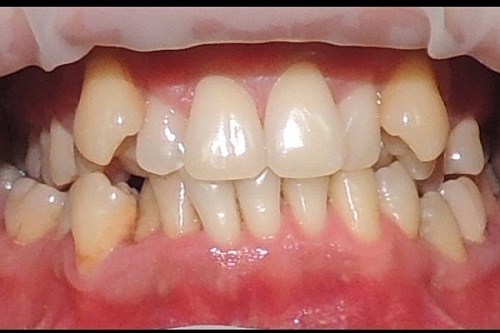 Лечение скученности зубов брекетами In Ovation R