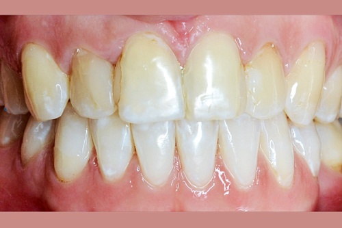 Установка виниров E-max