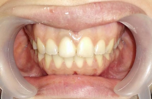 Выравнивание зубов брекетами Damon