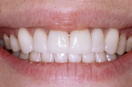 Установка виниров E-max