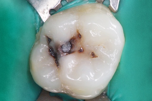 Лечение кариеса