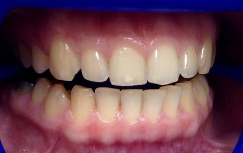 Клиническое отбеливание зубов Zoom White Speed