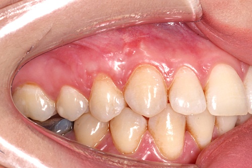 Закрытие рецессии четырнадцатого зуба