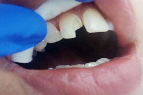 Восстановление зуба эстетической реставрацией